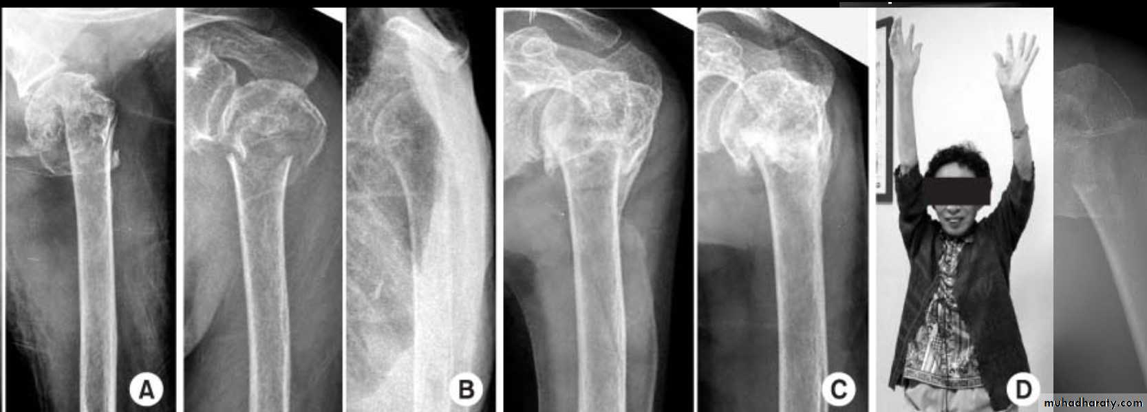 neer classification