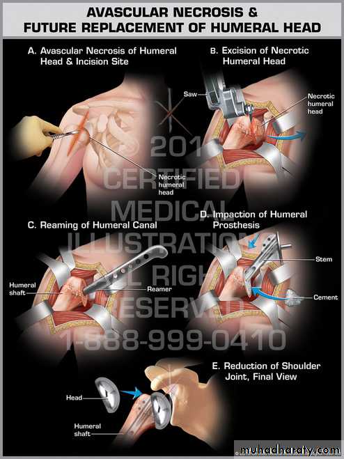 neer classification