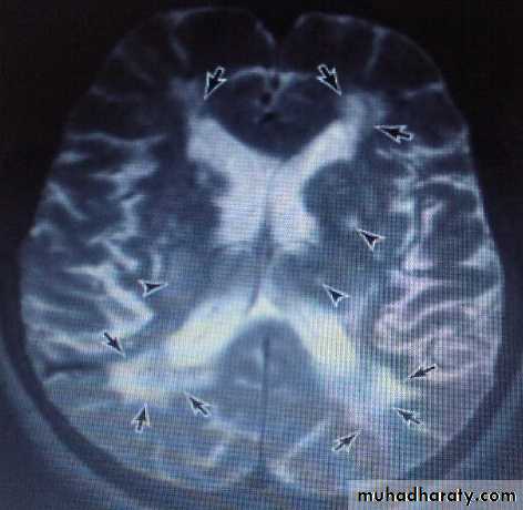 dementia word
