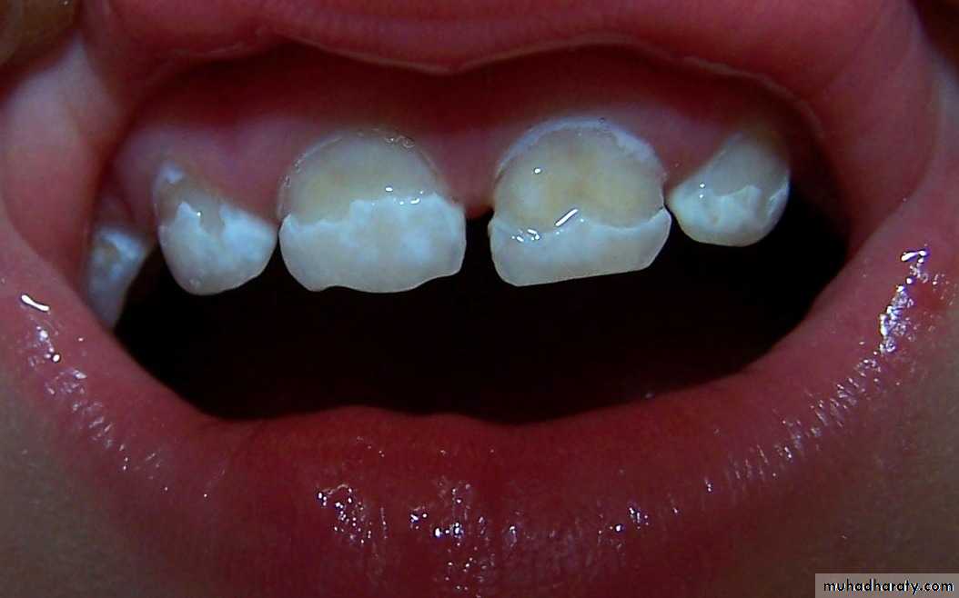 dental plaque
