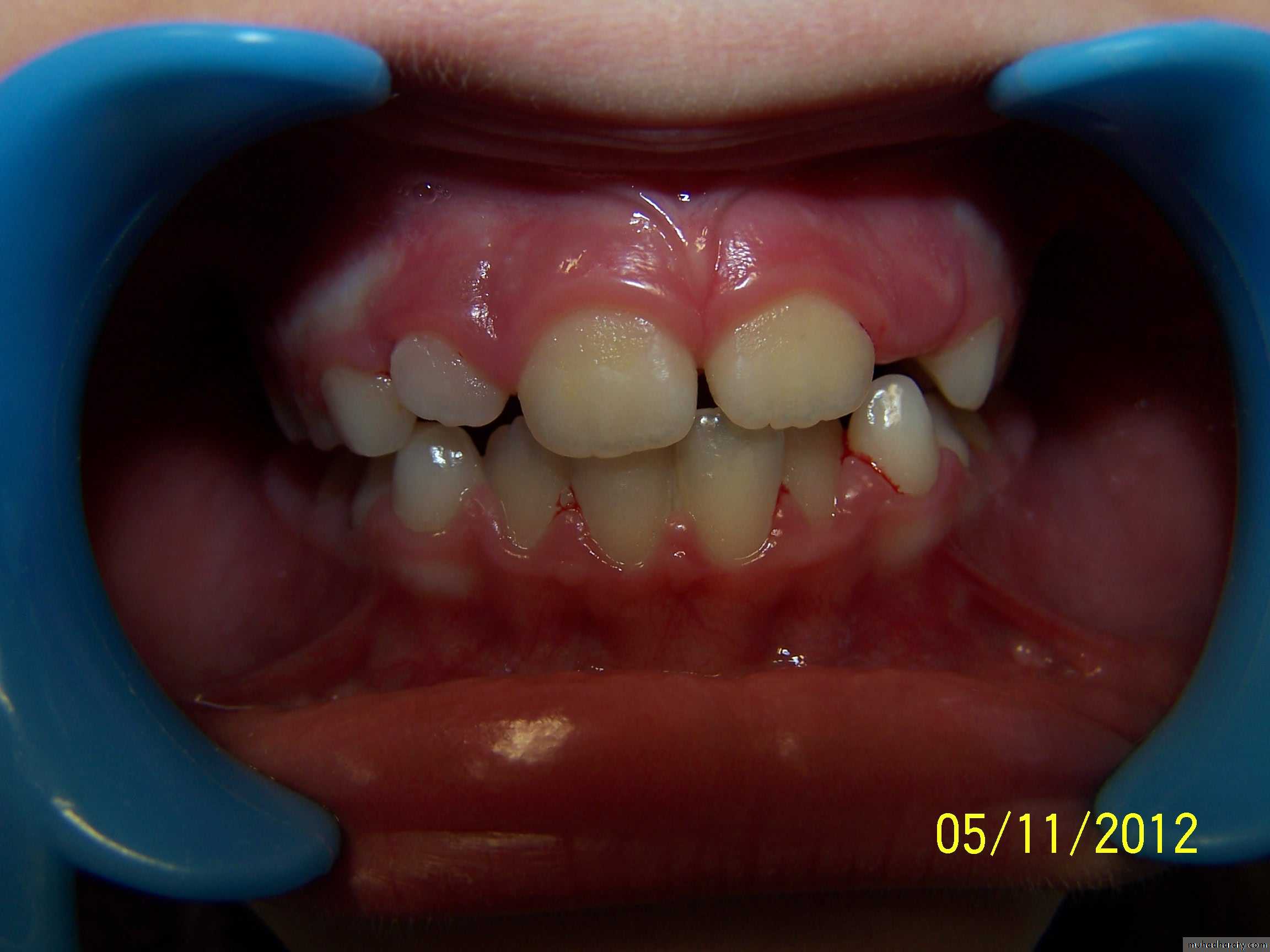 dental plaque