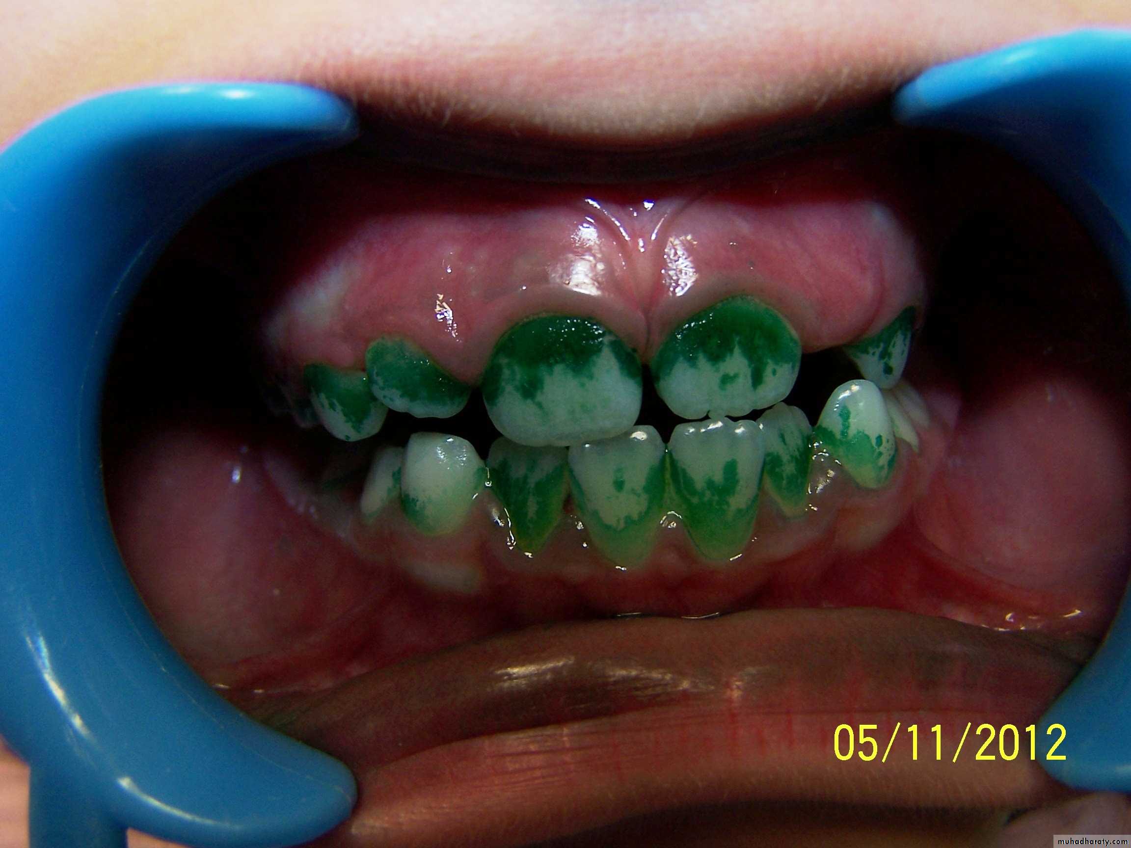 dental plaque