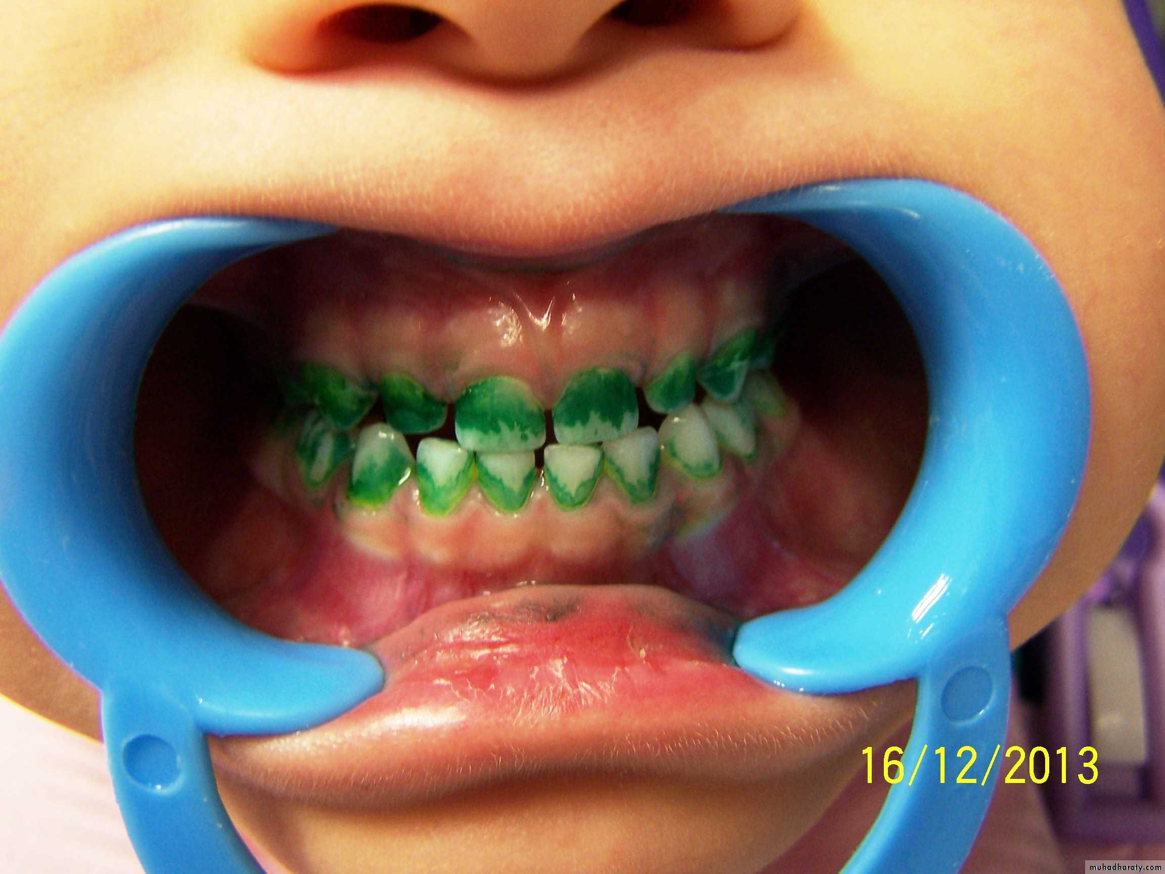 dental plaque