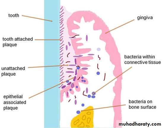 dental plaque