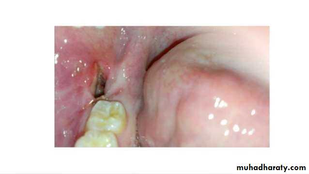 dry socket