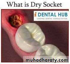 dry socket