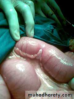 Small bowel