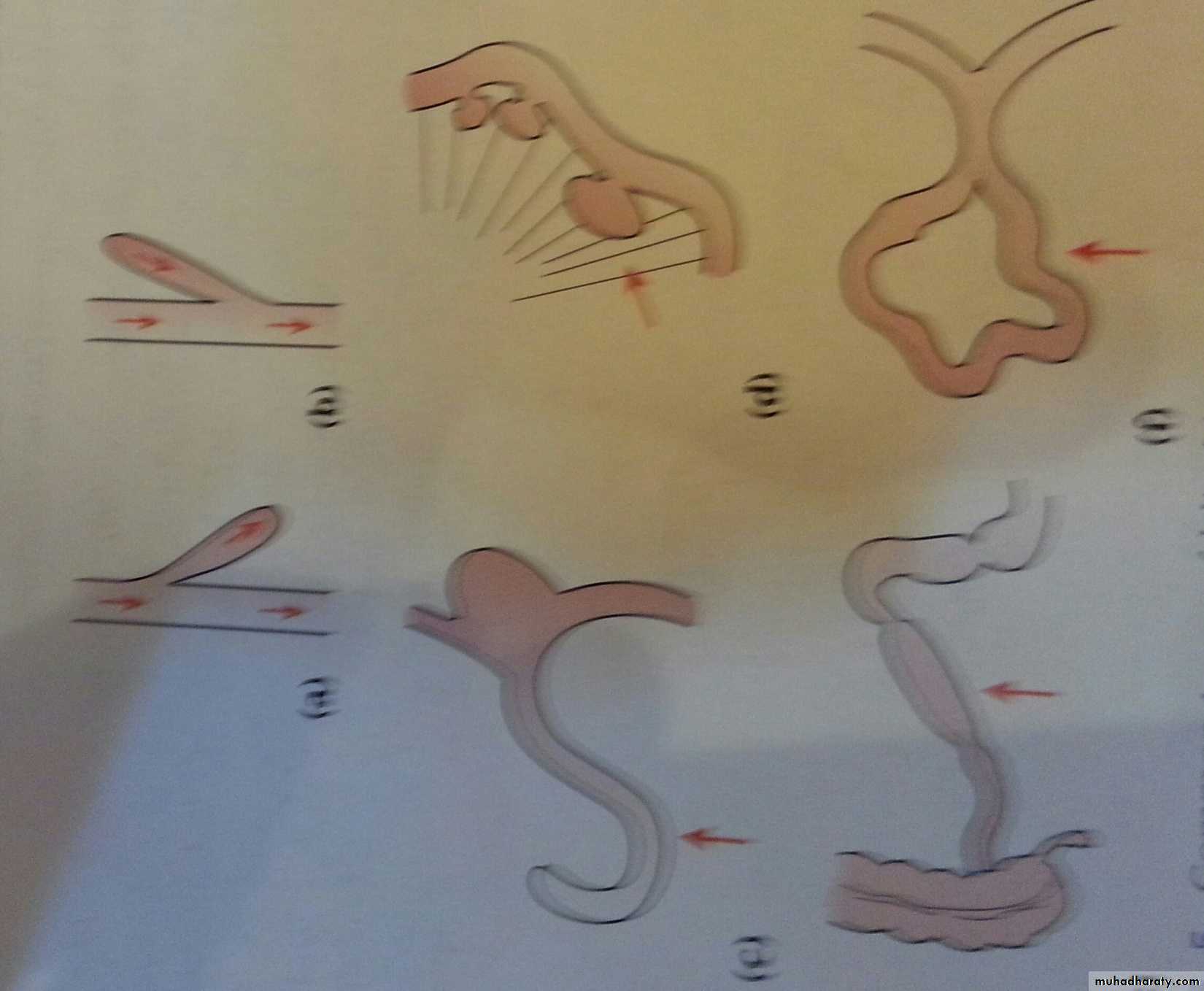 Small bowel