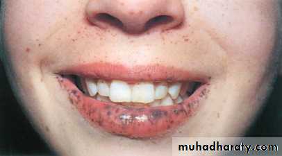 Small bowel