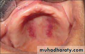 bleeding disorders