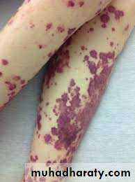 bleeding disorders