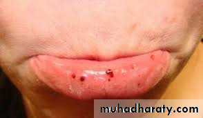 bleeding disorders