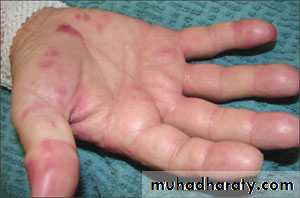 bleeding disorders