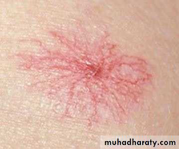 bleeding disorders