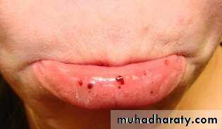 bleeding disorders