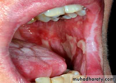 bleeding disorders