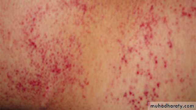 bleeding disorders