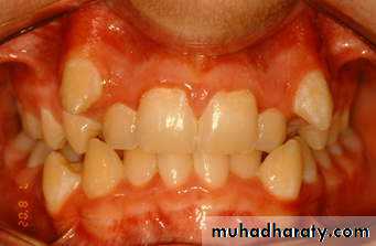 Removable Orthodontic Appliance