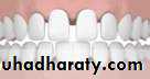Removable Orthodontic Appliance