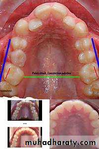 Removable Orthodontic Appliance