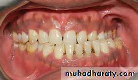 Removable Orthodontic Appliance