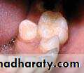Removable Orthodontic Appliance