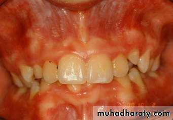 Removable Orthodontic Appliance