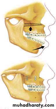 Removable Orthodontic Appliance