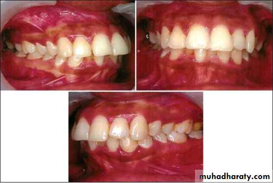 Removable Orthodontic Appliance