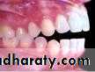 Removable Orthodontic Appliance