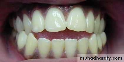 Removable Orthodontic Appliance