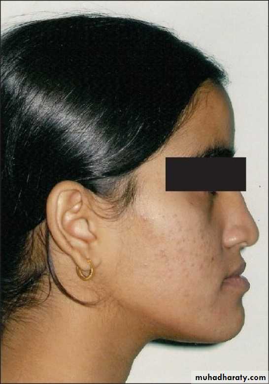 Removable Orthodontic Appliance
