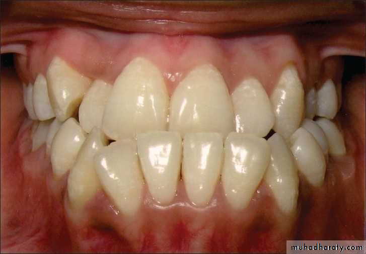 Removable Orthodontic Appliance