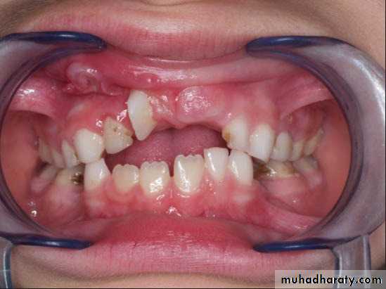 Removable Orthodontic Appliance