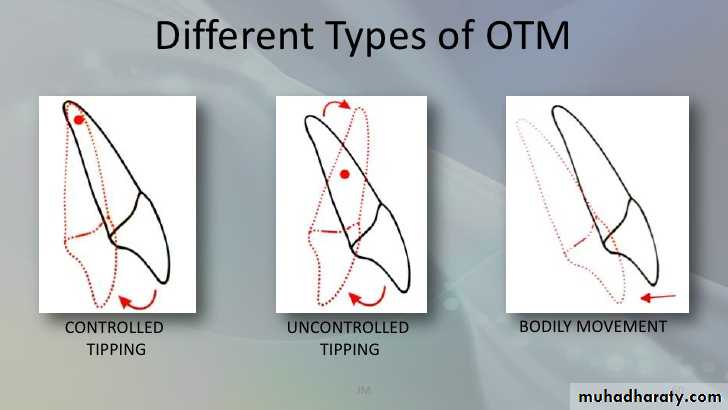Removable Orthodontic Appliance