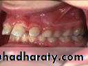 Removable Orthodontic Appliance