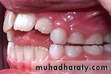 Removable Orthodontic Appliance
