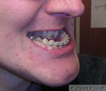 Removable Orthodontic Appliance