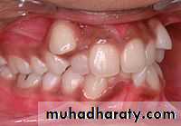 Removable Orthodontic Appliance