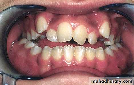 Removable Orthodontic Appliance