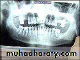 Removable Orthodontic Appliance