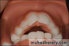 Removable Orthodontic Appliance
