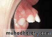 Removable Orthodontic Appliance