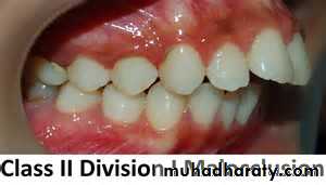 Removable Orthodontic Appliance