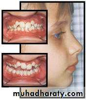 Removable Orthodontic Appliance