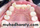 Removable Orthodontic Appliance