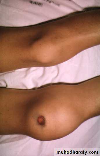 Bleeding