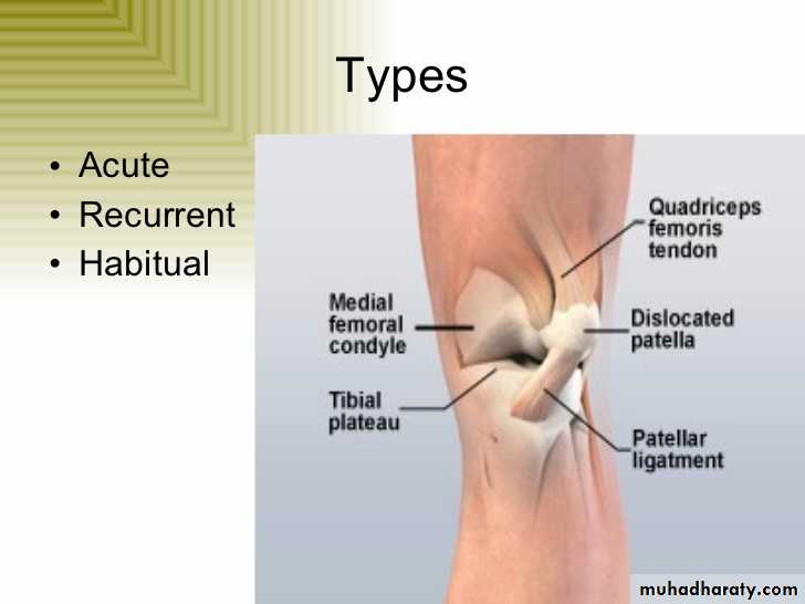 patellar dislocation