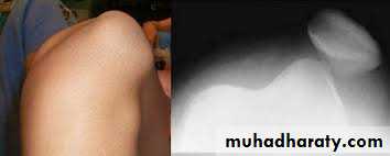 patellar dislocation