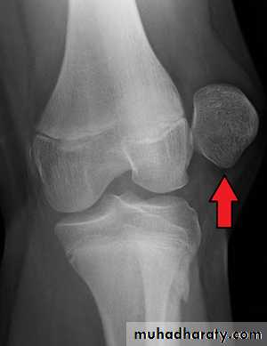 patellar dislocation